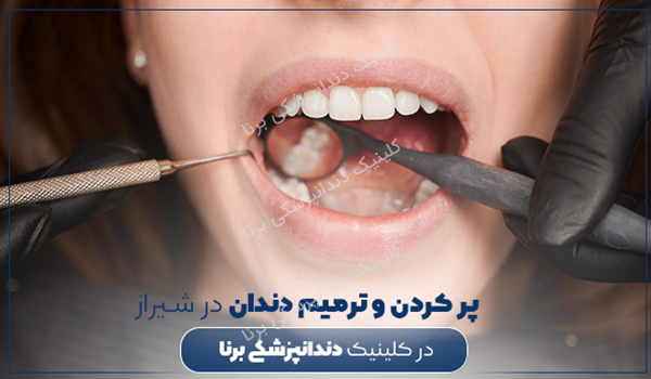 پر کردن و ترمیم دندان در شیراز